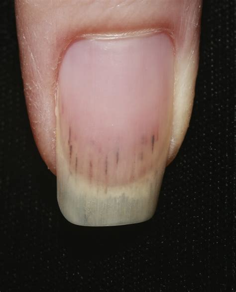 pictures of black lines on fingernails